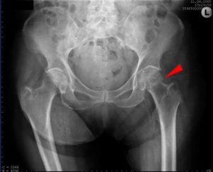 stress fracture of the femoral neck