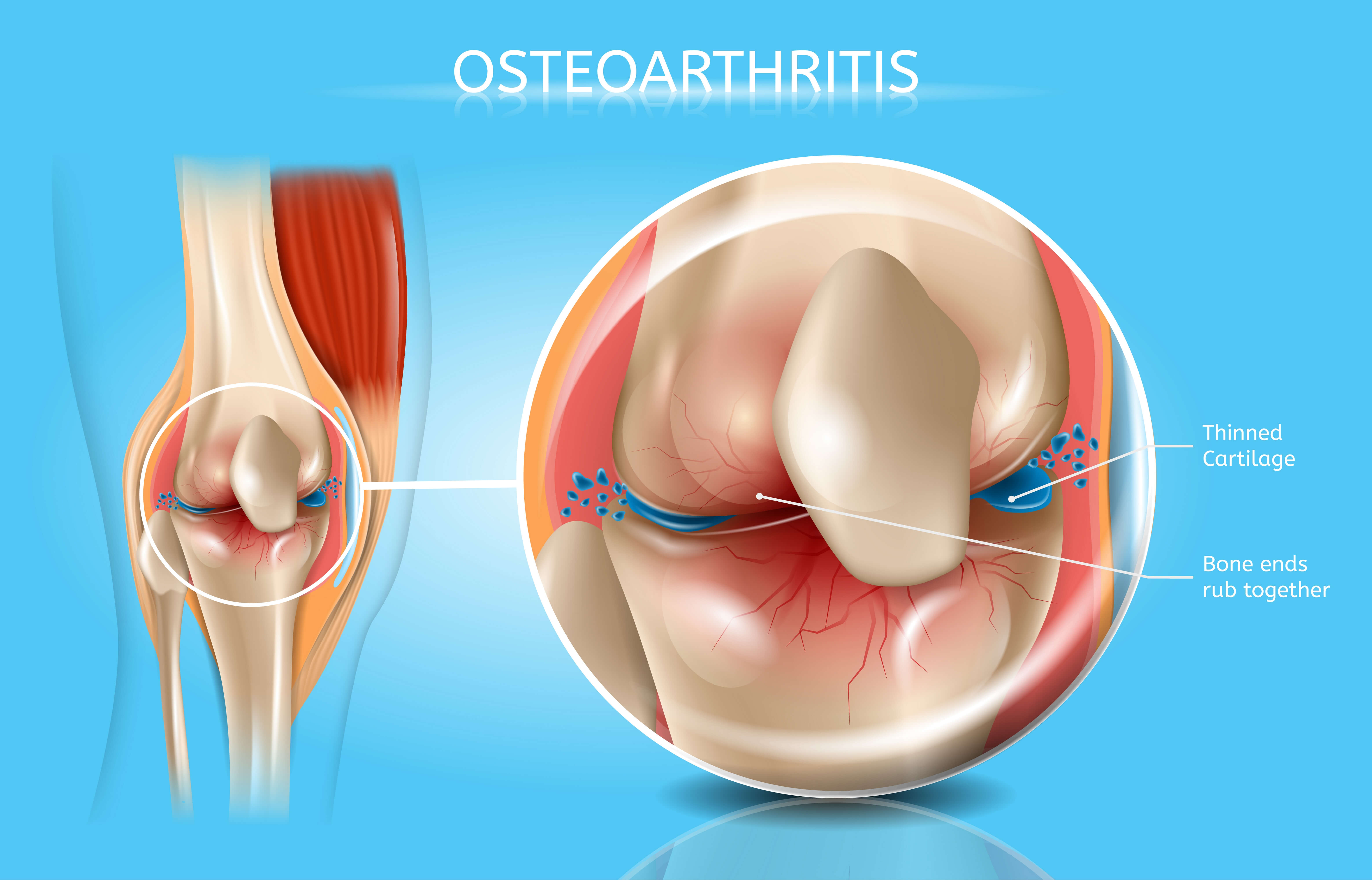 physiotherapy for osteoarthritis