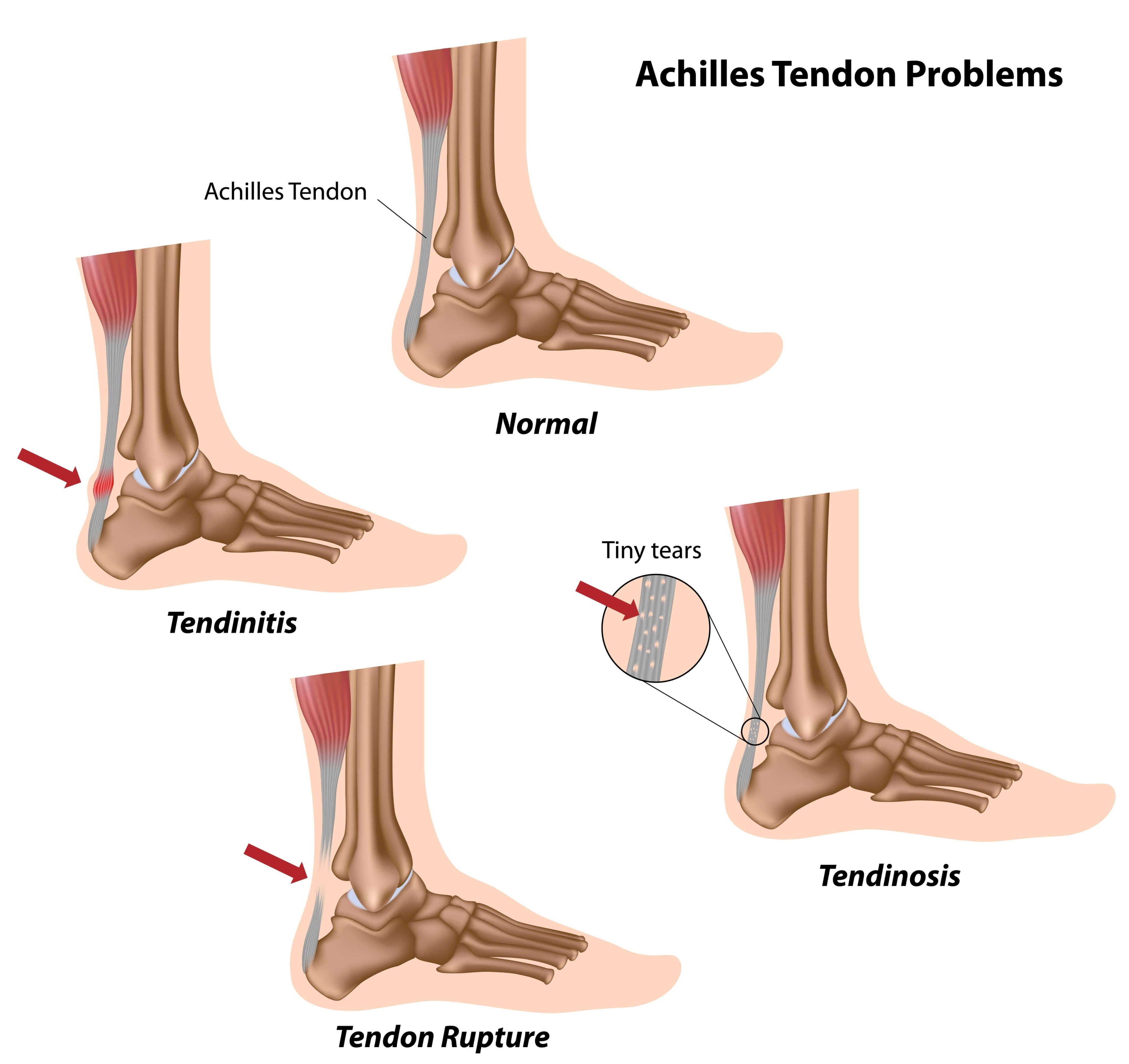 Сильно болят ноги после ходьбы. Ахиллово сухожилие воспаление. Тендинит ахиллова сухожилия.